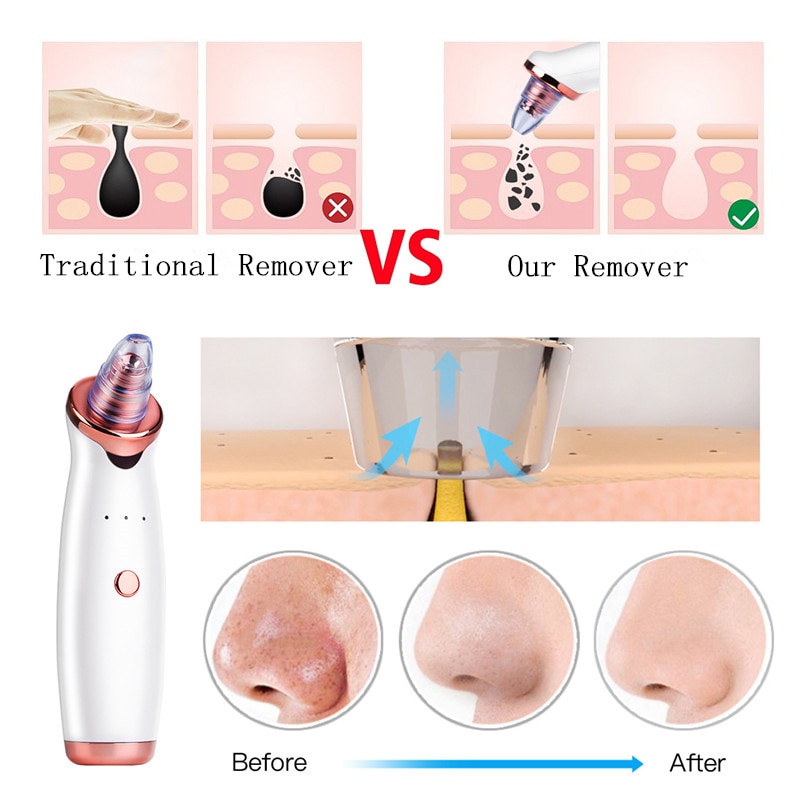 Blackhead-Remover-Vacuum-Electric-Nose-Beauty-Face-Deep-Cleansing-Skin-Care-Vacuum-Black-Spots-Acne-Pore-1.jpg